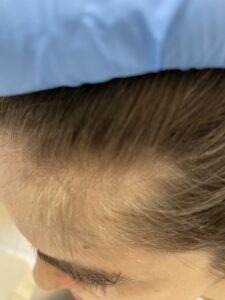 small webp Trycholog Bydgoszcz – Milena Kwaśniewska, specjalizuję się w diagnostyce i leczeniu problemów skóry głowy oraz włosów, oferując profesjonalne konsultacje i indywidualnie dobrane terapie. Nowa 15, 85-119 Bydgoszcz https://milena-trycholog.pl